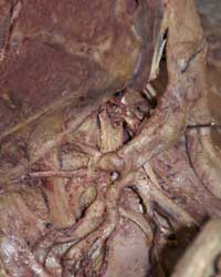 Left Iliac Arteries