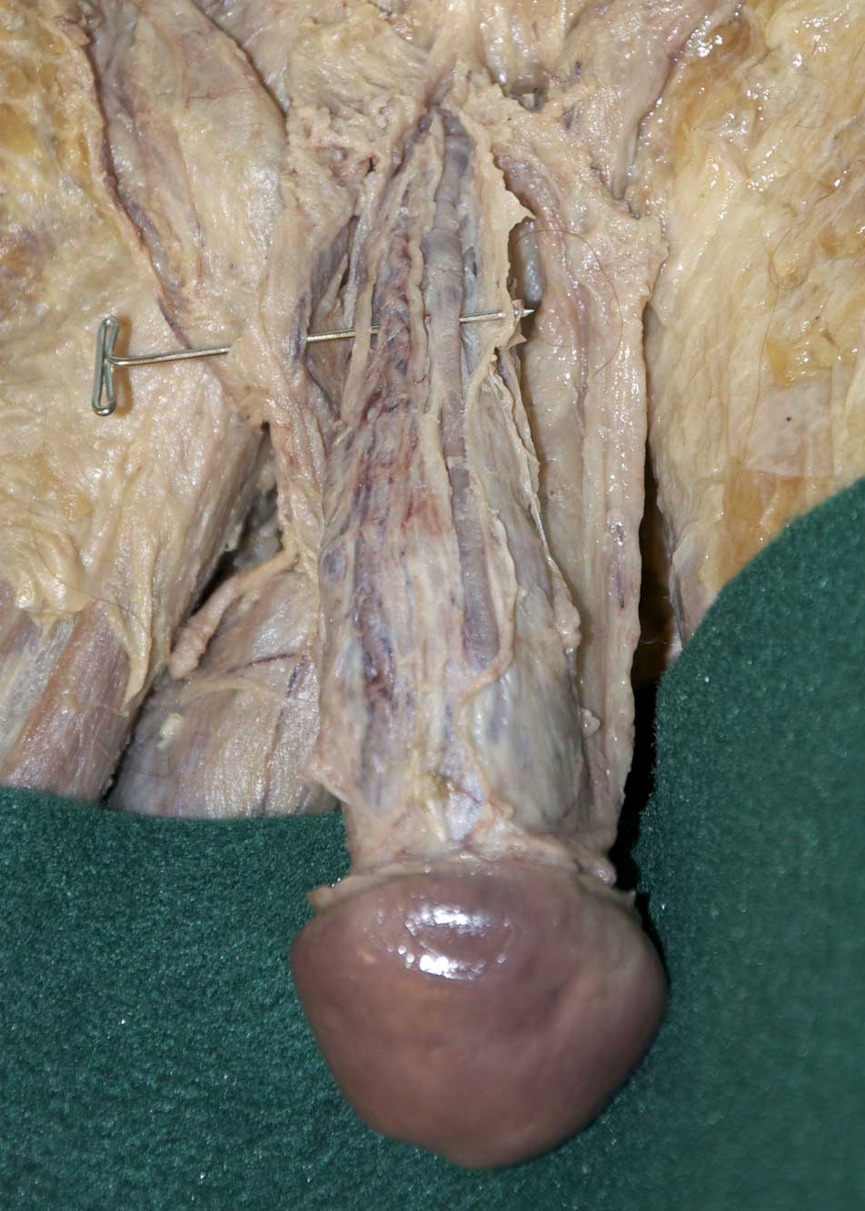 Male Perineum - 2