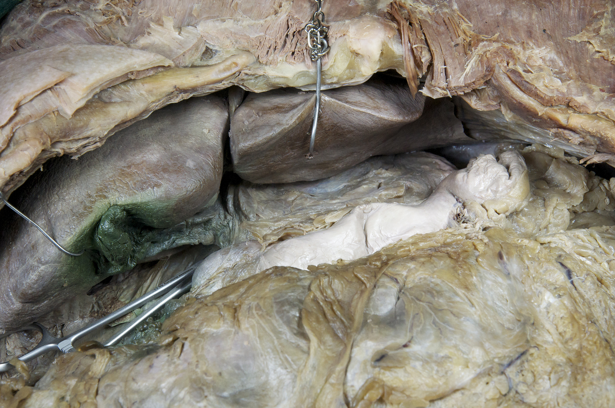 Peritoneal Cavity - 4