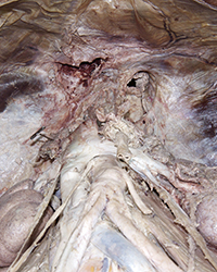 Diaphragm