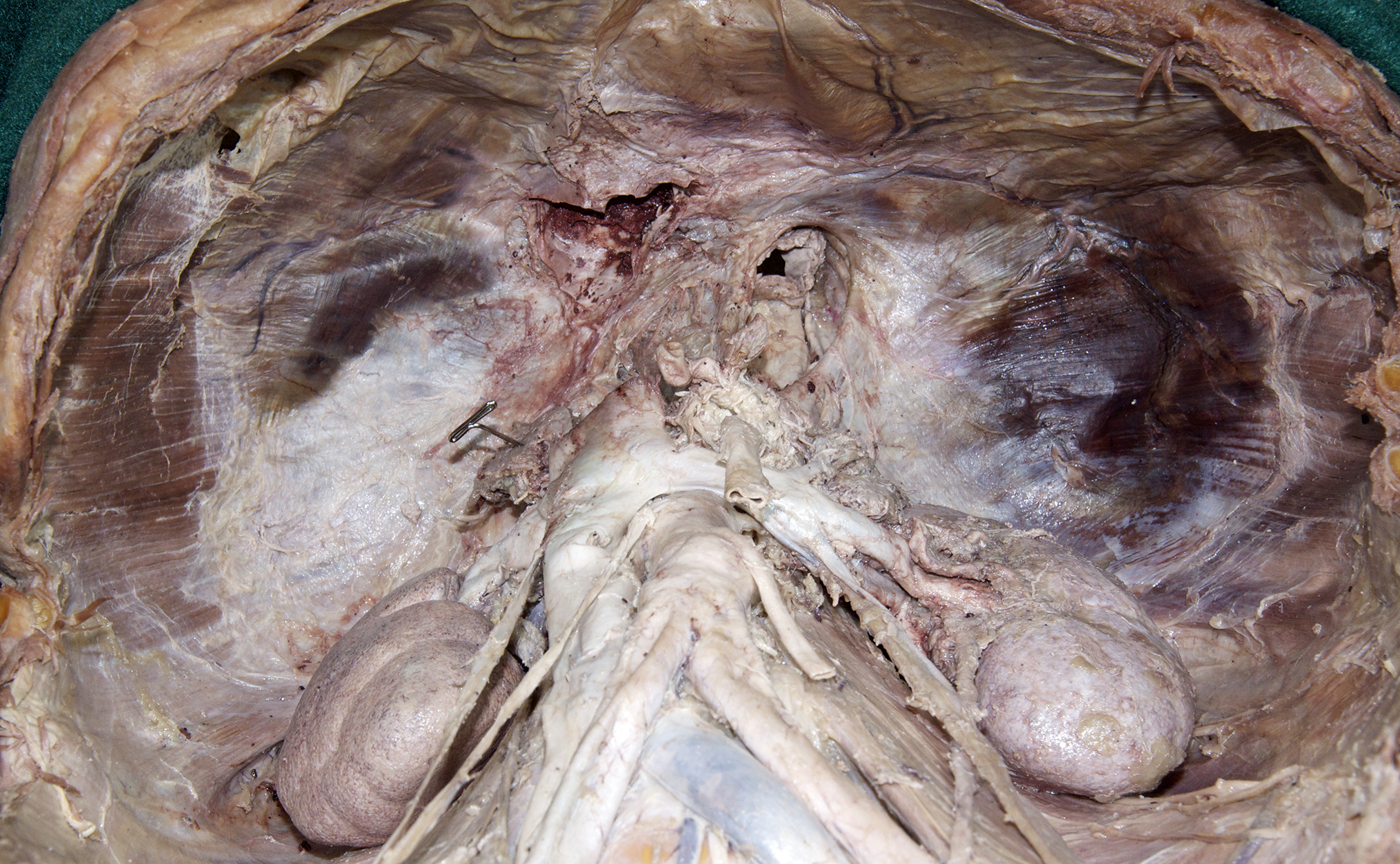 Posterior Abdominal Wall - 5