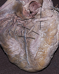 Left Ventricle