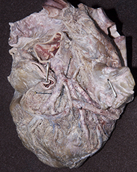 Left Ventricle