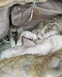 Abdominal Aorta