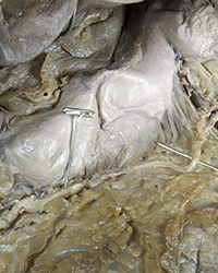 Abdominal Aorta