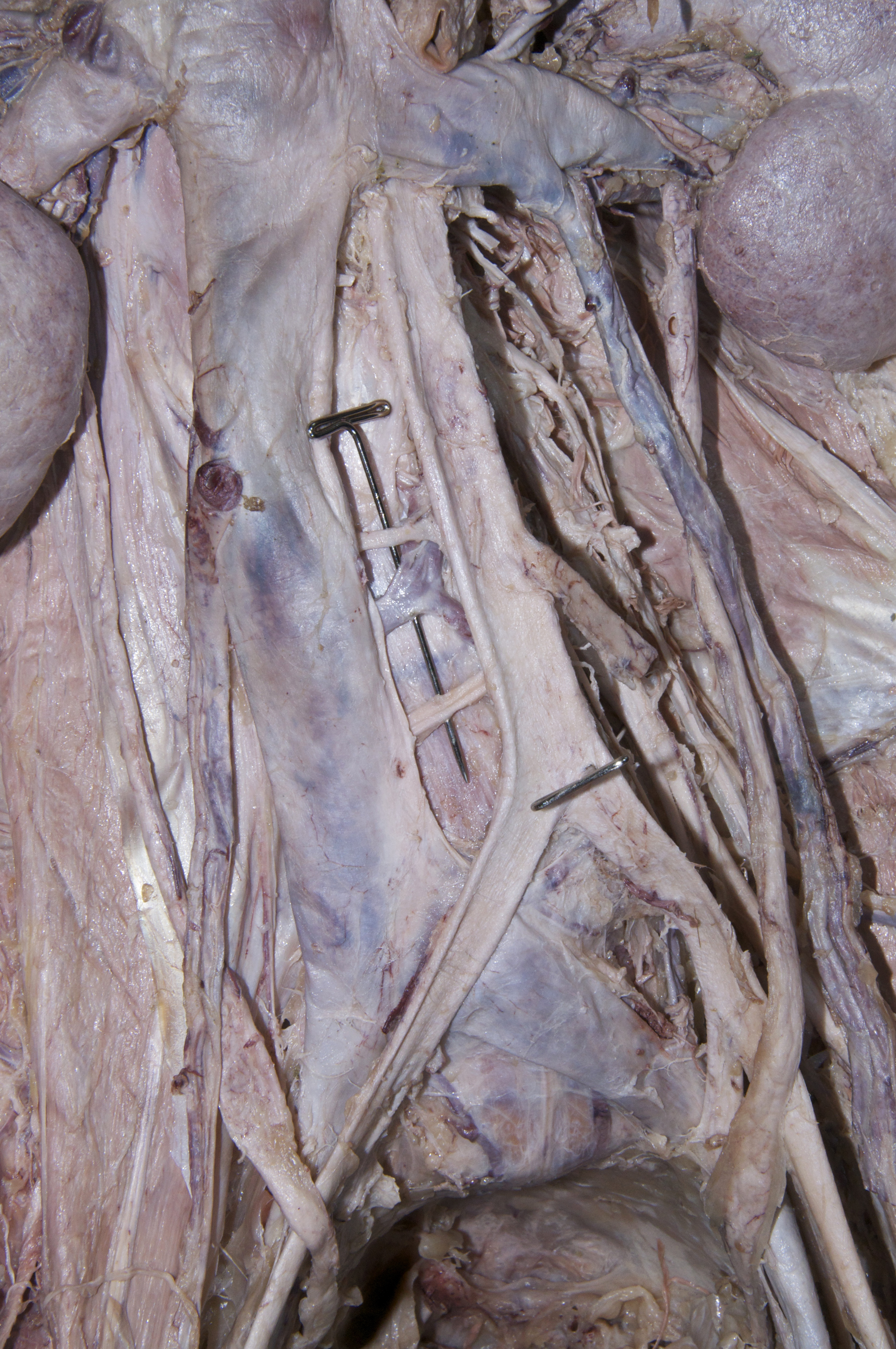 Posterior Abdominal Wall - 6