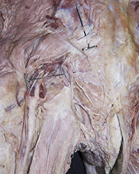 Ischiorectal Fossa