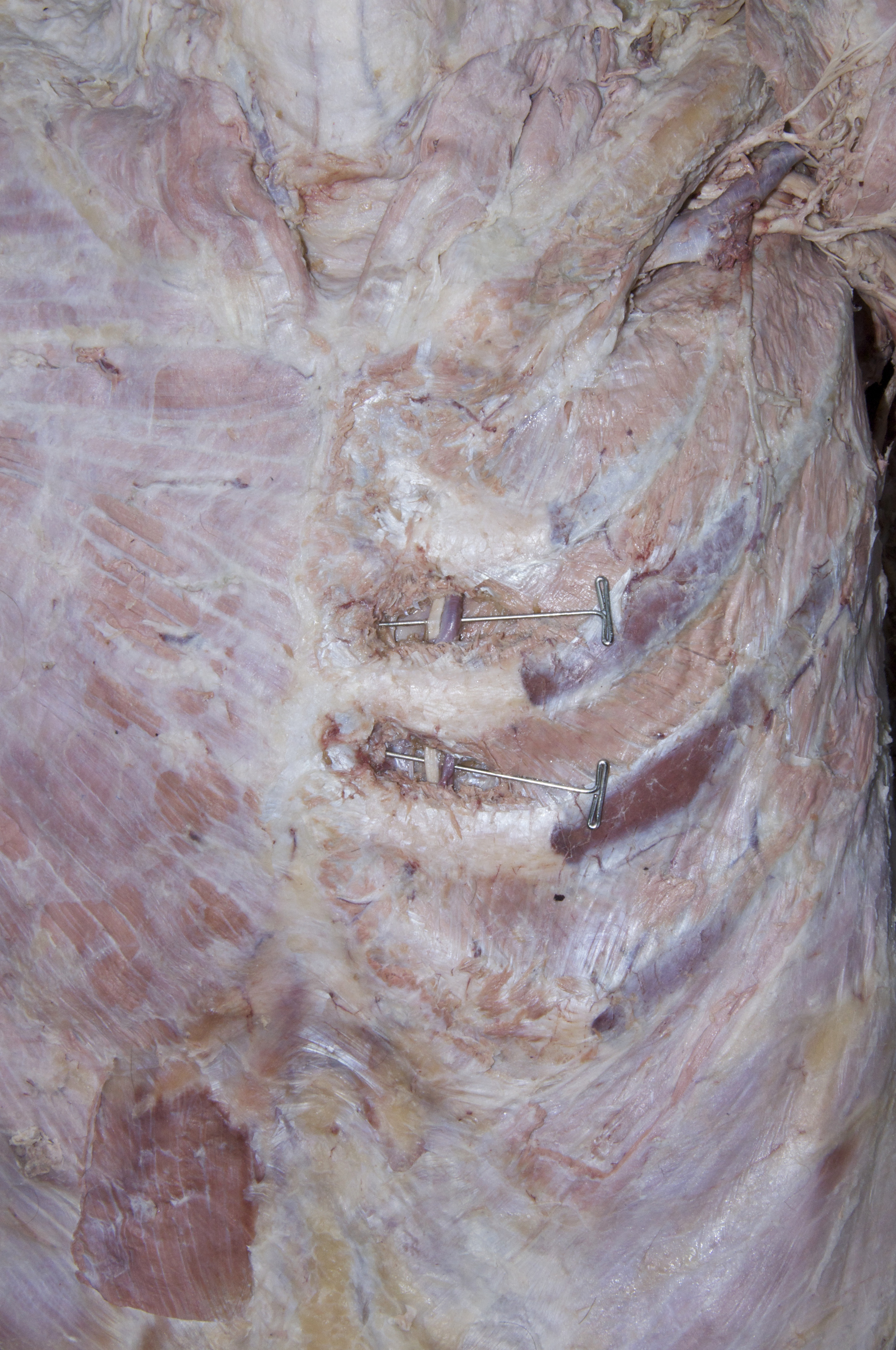 Thoracic Wall - 4