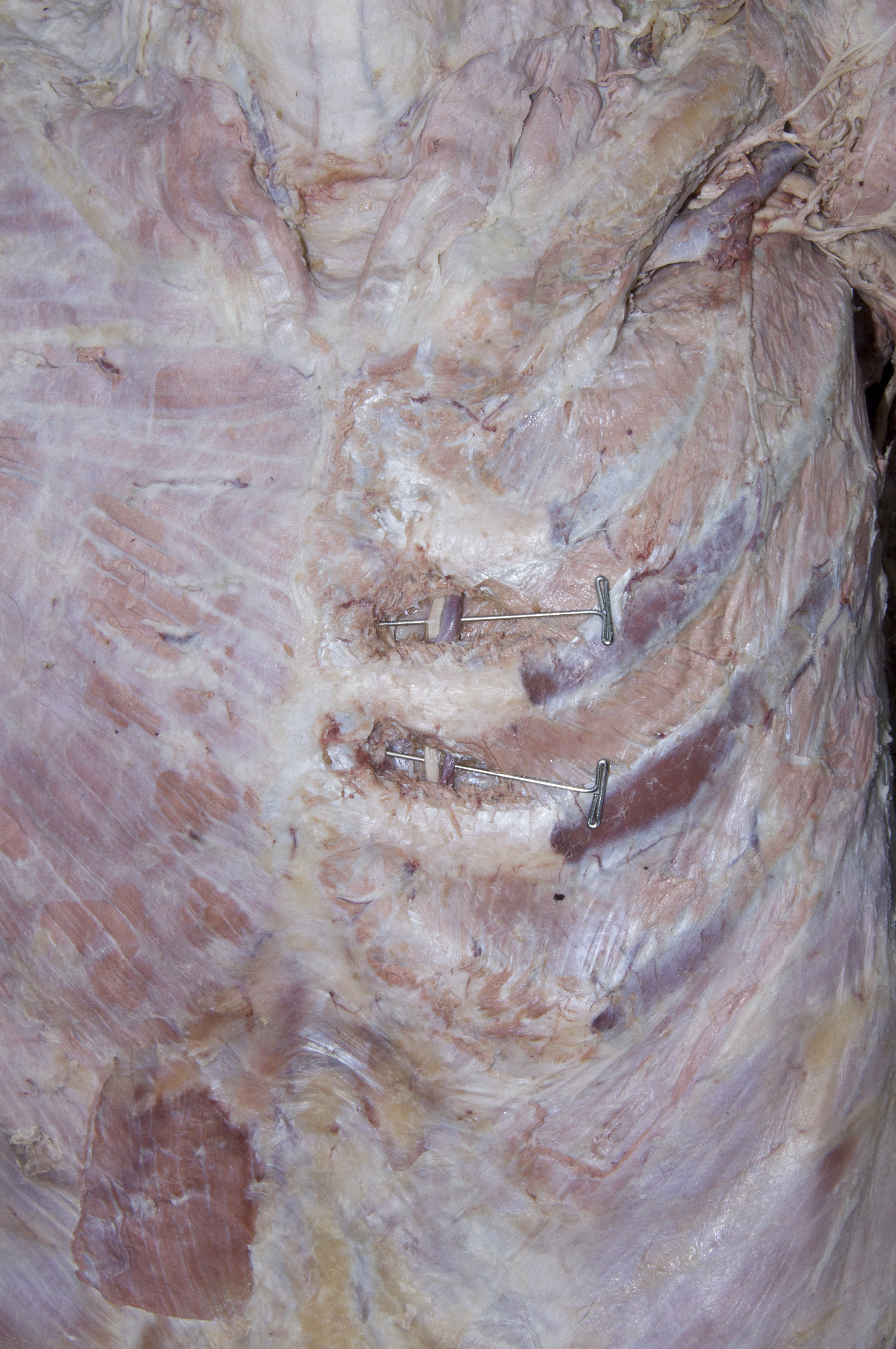 Thoracic Wall - 4