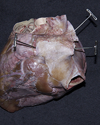 Left Ventricle