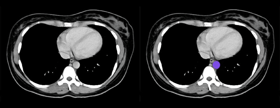 Aorta