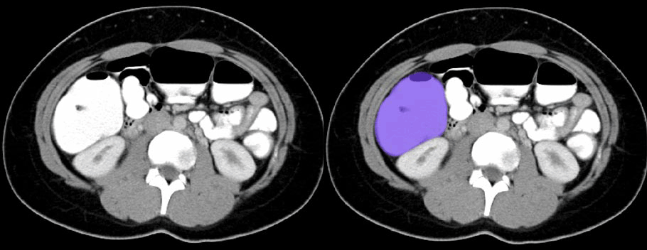 Ascending Colon