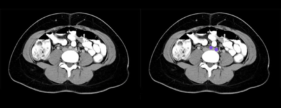 Common Iliac Arteries