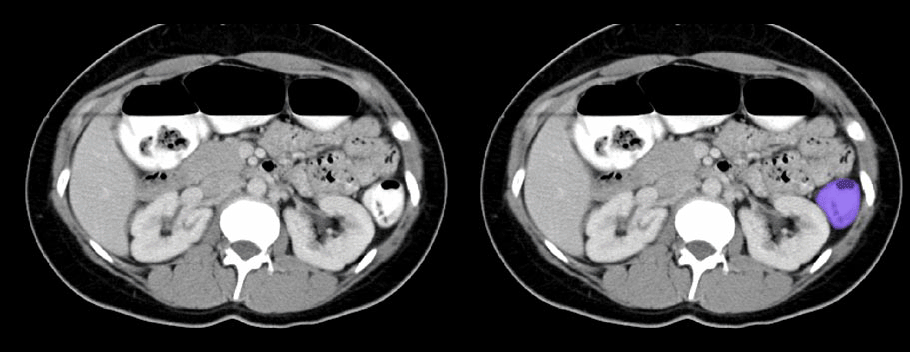 Descending Colon