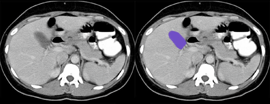 Gallbladder
