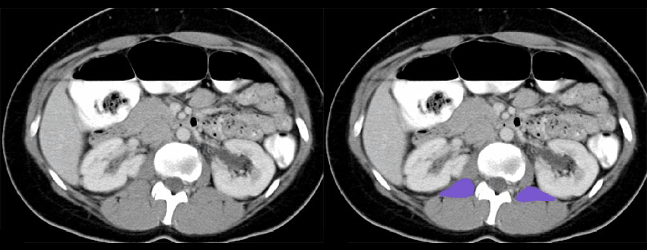Quadratus Lumborum