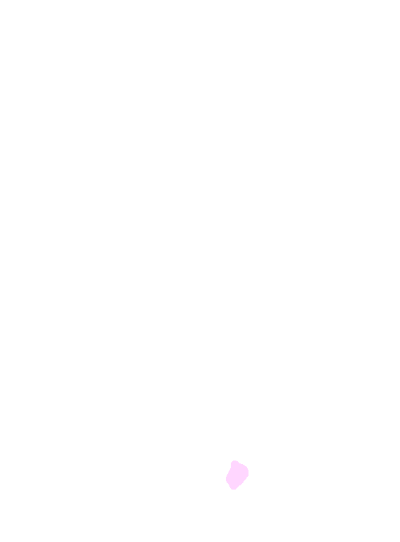 Trapezium Tubercle