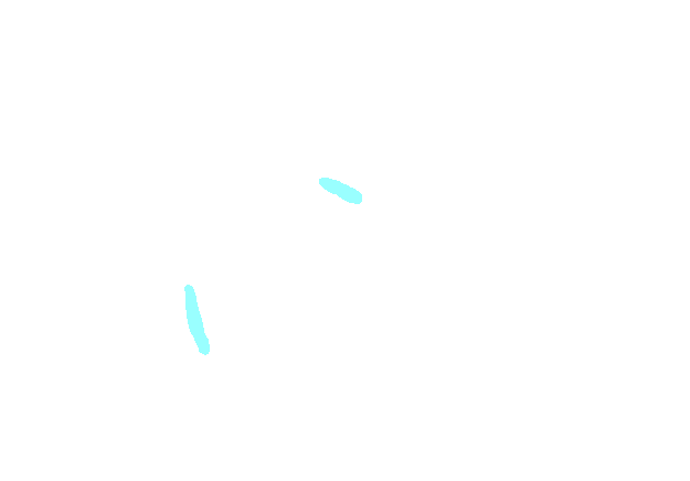 Coracoacromial Ligament