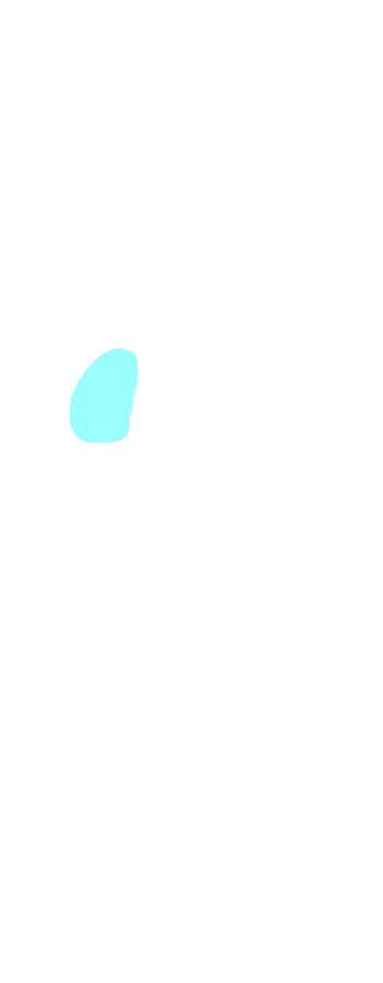 Radial Notch