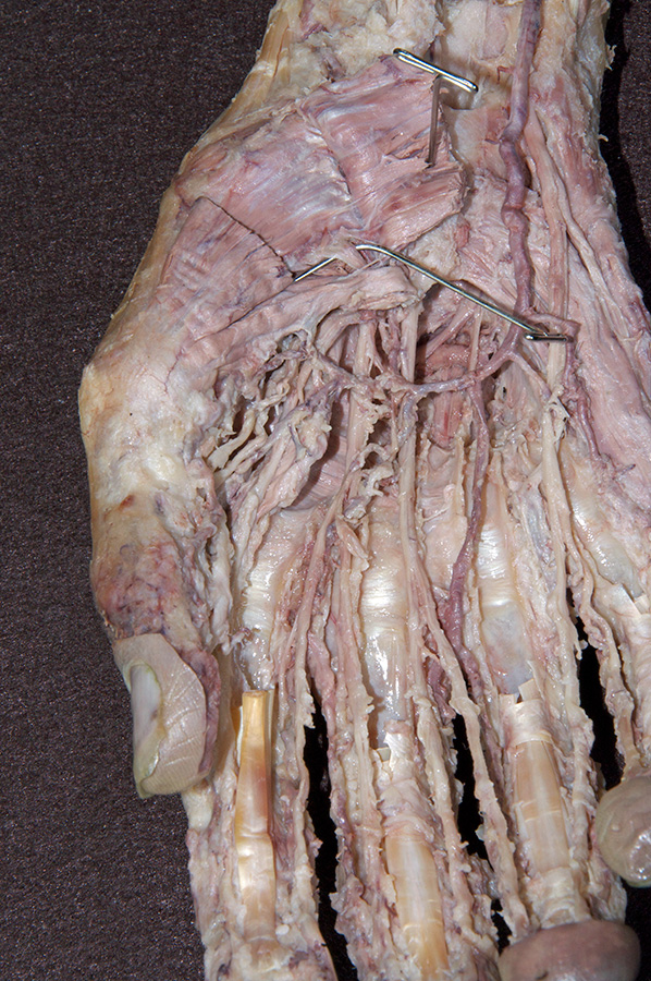 Opponens Pollicis Muscle