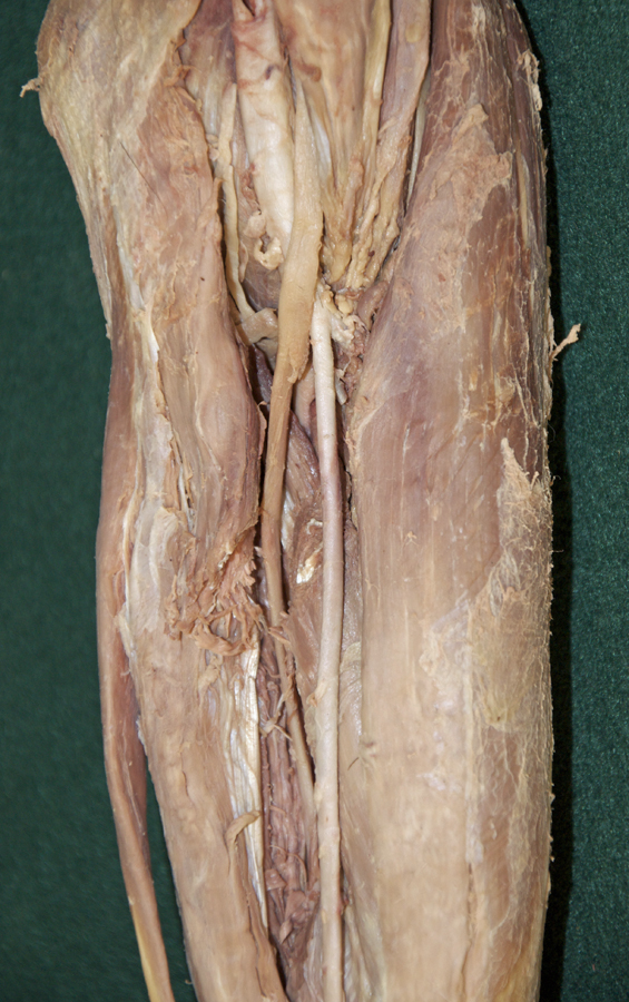 Sectioned Pronator Teres Muscle