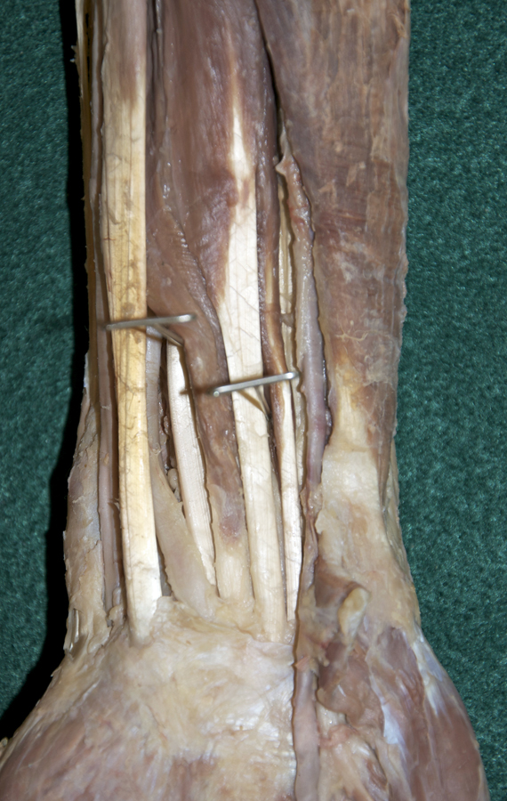 Flexor Digitorum Superficialis Tendons