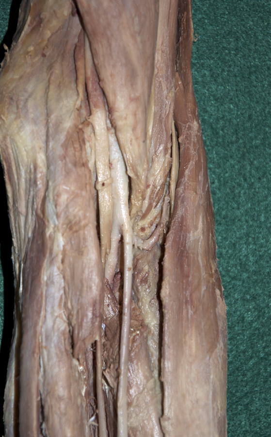 Left Radial Recurrent Artery