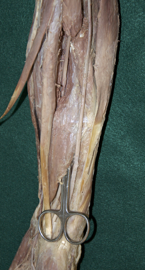 Sectioned Flexor Digitorum Superficialis Muscle