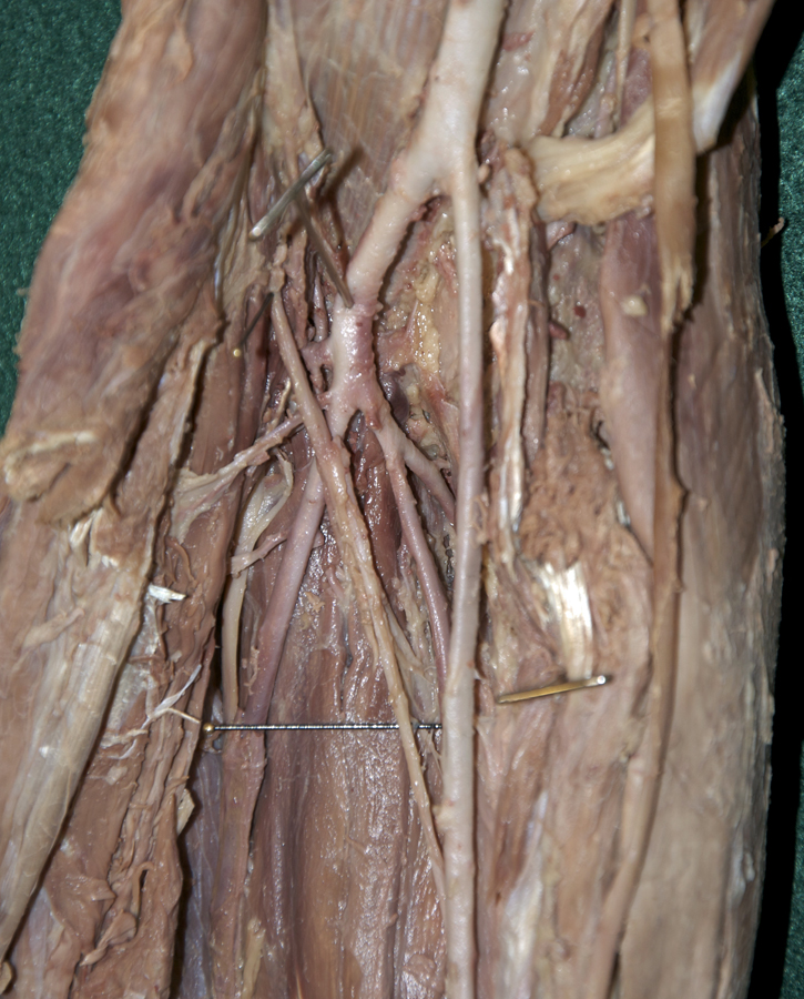 Left Interosseous Arteries