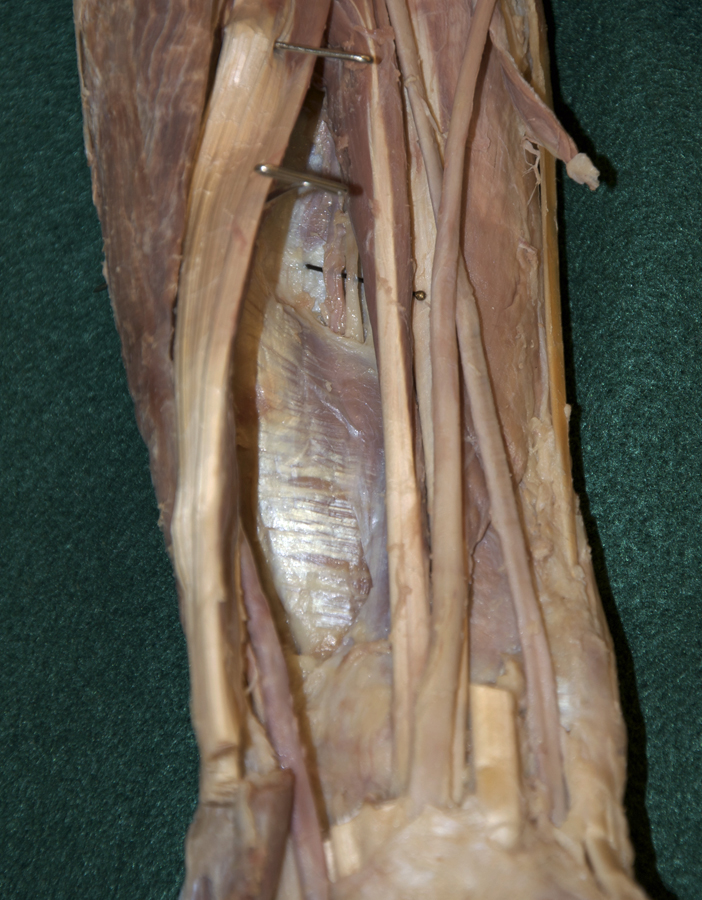 Pronator Quadratus Muscle