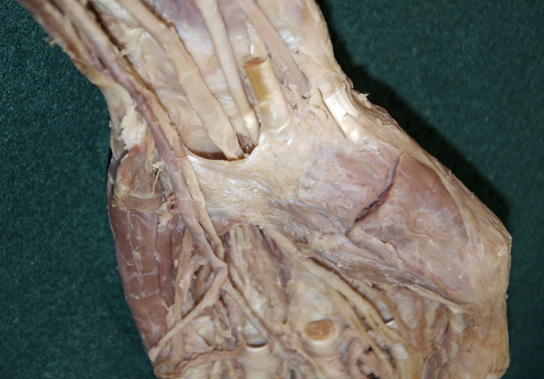 Transverse Carpal Ligament