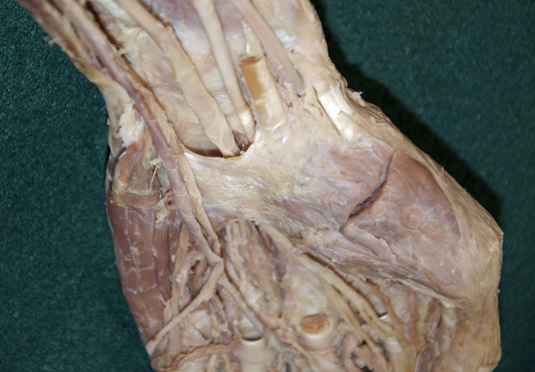 Left Transverse Carpal Ligament