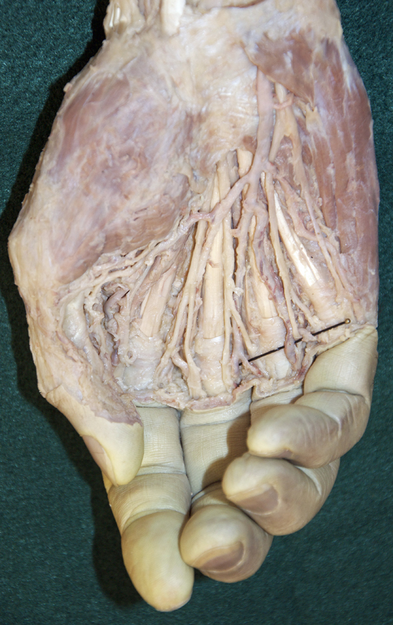 Superficial Palmar Arterial Arch