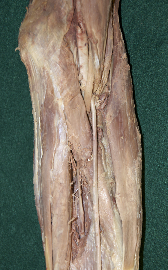 Pronator Teres Muscle and Median Nerve