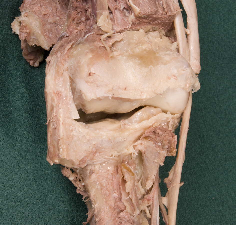 Radial Collateral Ligament