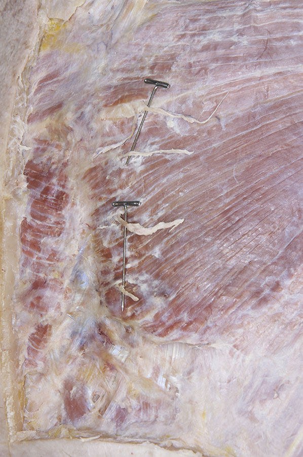 Anterior Cutaneous Branches of Thoracic Nerves (penetrating pectoralis major muscle)
