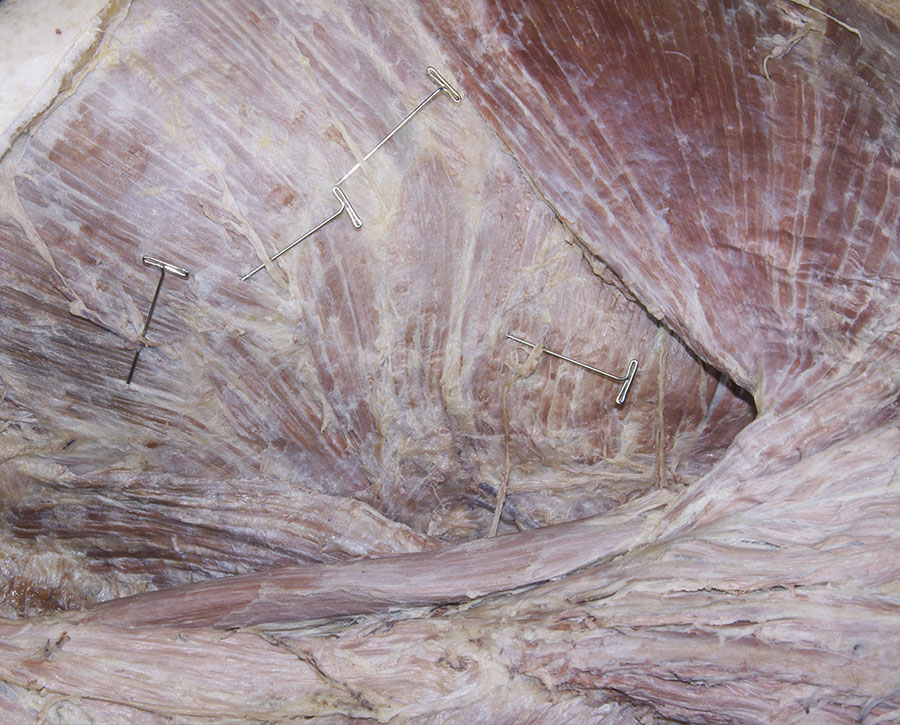 Lateral Cutaneous Branches of Thoracic Nerves