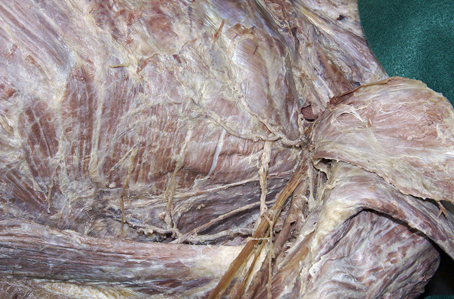 Intercostobrachial Nerve