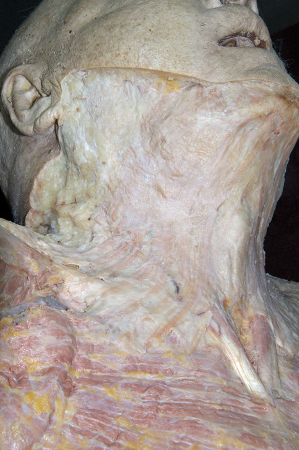 Platysma Reflected