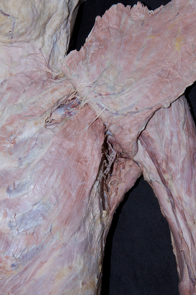 Pectoralis Minor Muscle