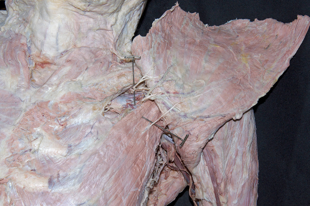 Pectoral Nerves