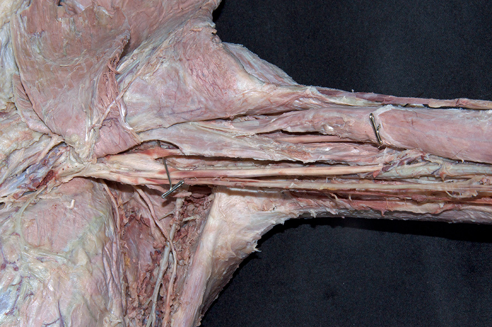 Coracobrachialis Muscle