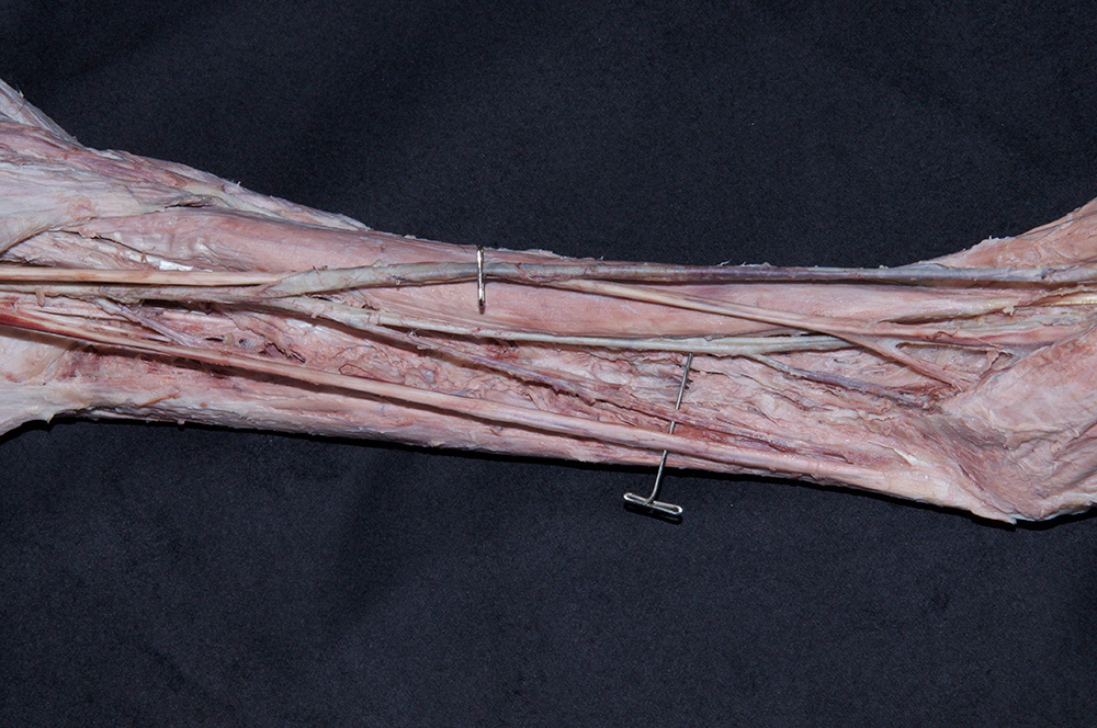 Superior Ulnar Collateral Artery