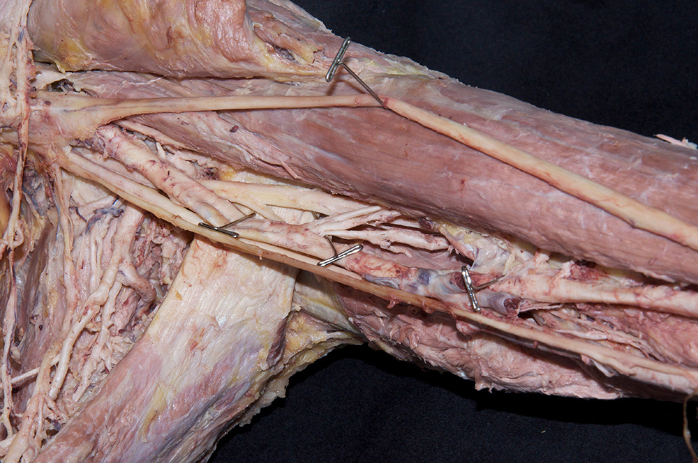 Profunda Brachii Artery