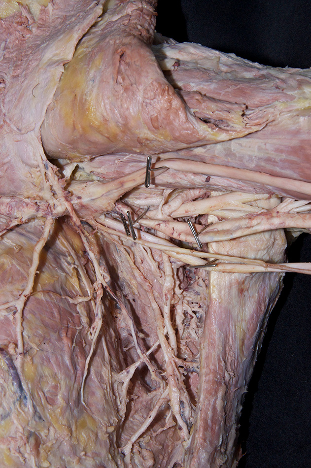 Anterior and Posterior Circumflex Humeral Arteries