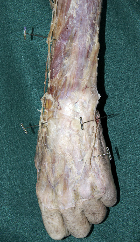 Cutaneous Nerves of Dorsal Hand