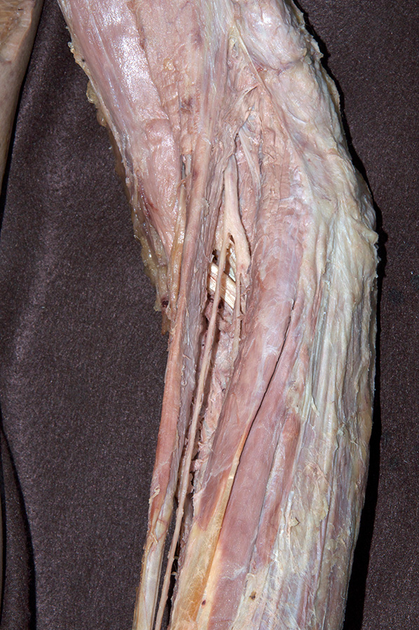 Superficial and Deep Branches of the Radial Nerve