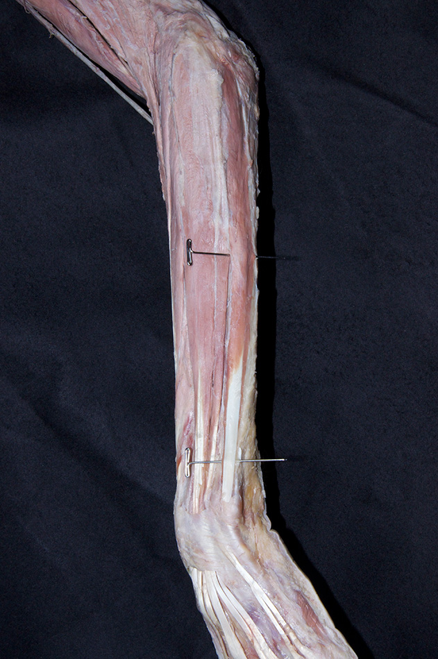 Extensor Carpi Ulnaris Muscle