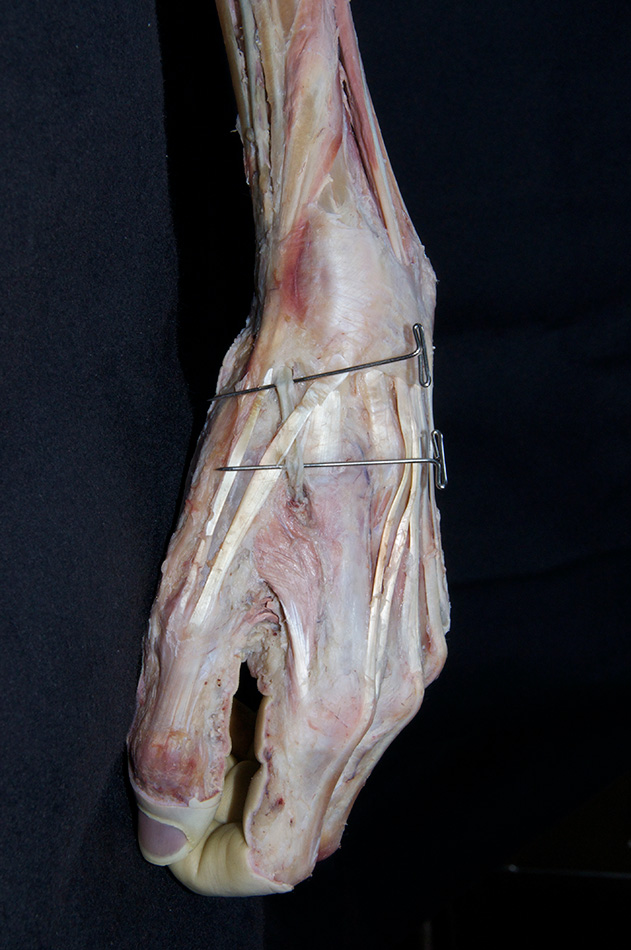 Radial Artery