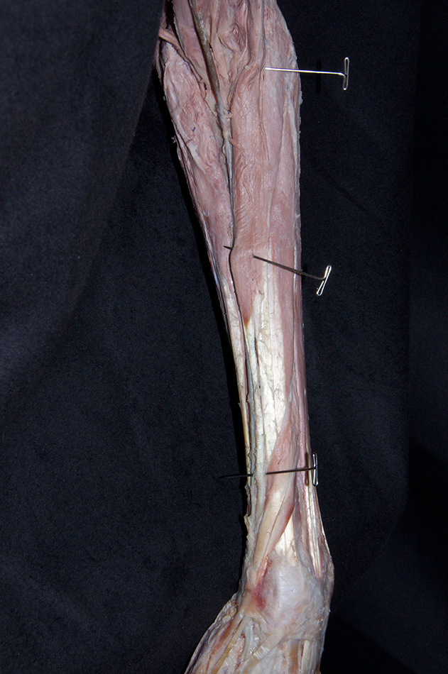 Brachioradialis Muscle